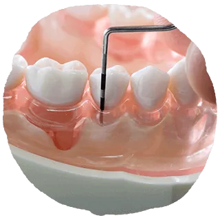 歯周病治療の写真