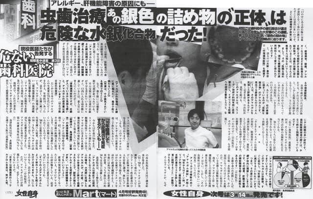アマルガムについての記事画像