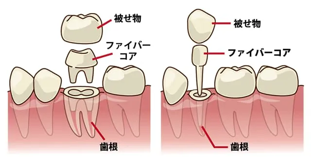 ファイバーコア