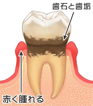 軽度の歯周炎