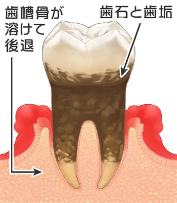 中等度の歯周炎