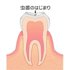 初期のむし歯 (C0)