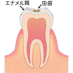 エナメル質のむし歯 (C1)