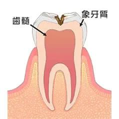 象牙質のむし歯 (C2)