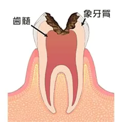 神経に届いたむし歯 (C3)