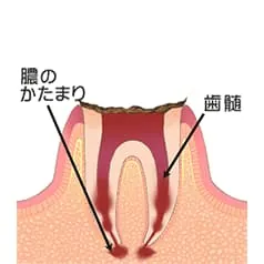 神経に届いたむし歯 (C4)